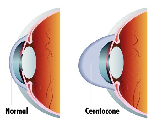 Ceratocone causa deformação no formato da córnea.