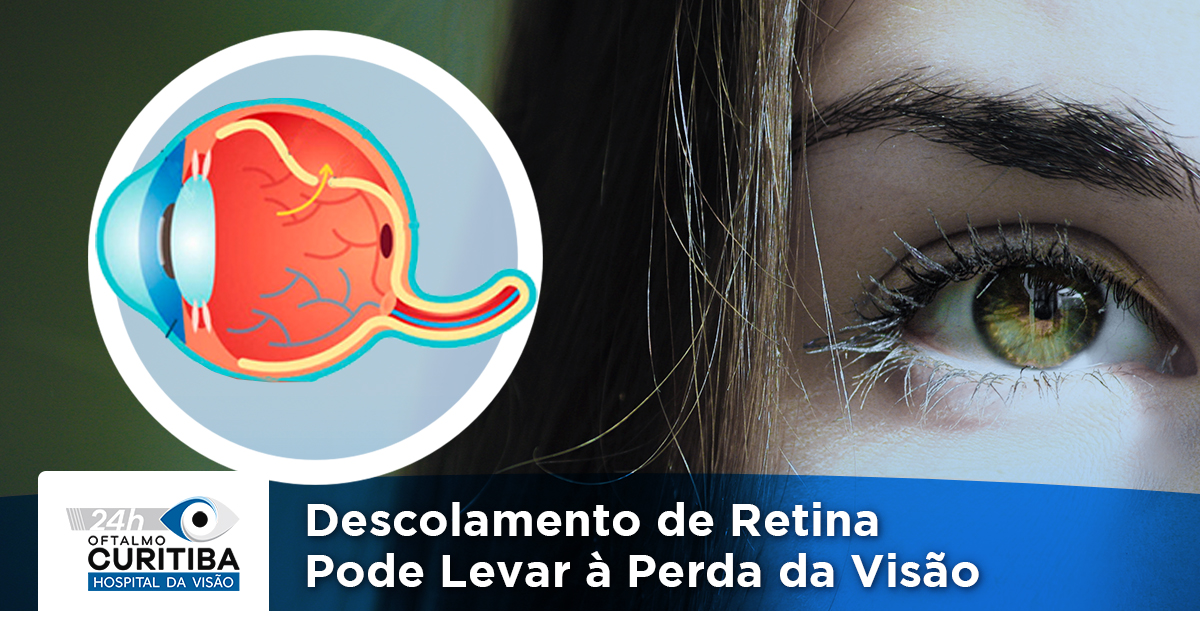 O descolamento de retina é considerado caso de urgência! - NeoOftalmo