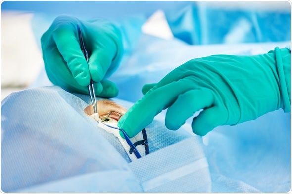 cirurgia do pterígio curitiba