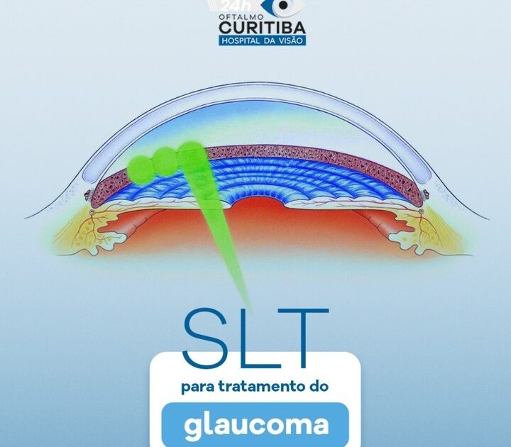 Entenda a respeito do procedimento Selective Laser Trabeculoplasty (SLT)