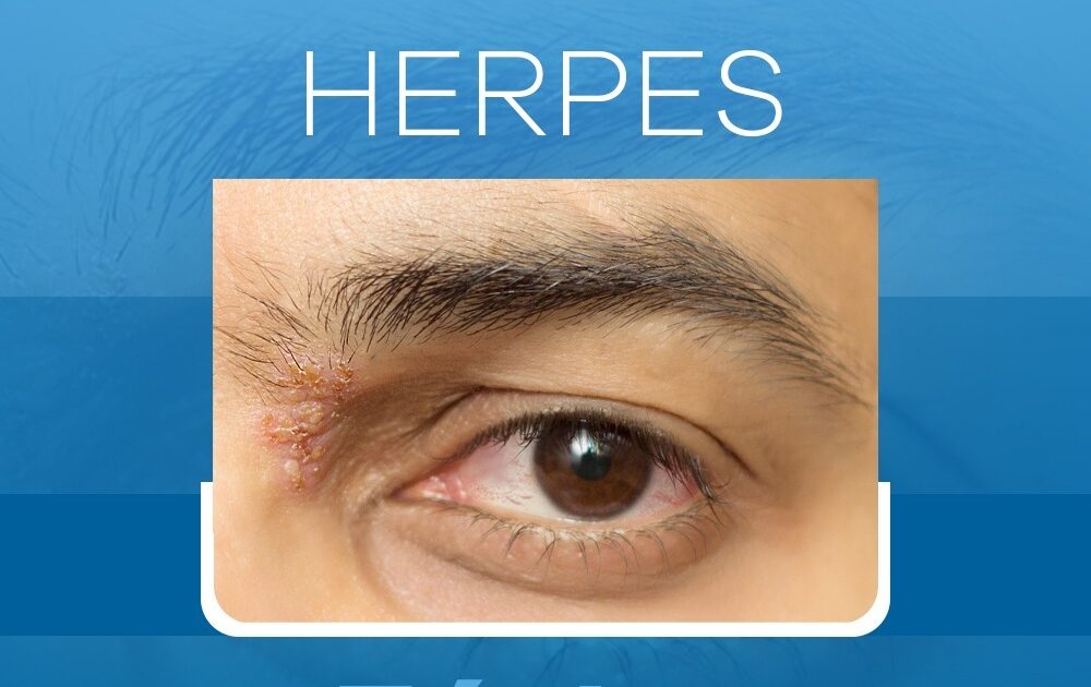 Entenda o Que é a Infecção Herpes Zoster Oftalmológico