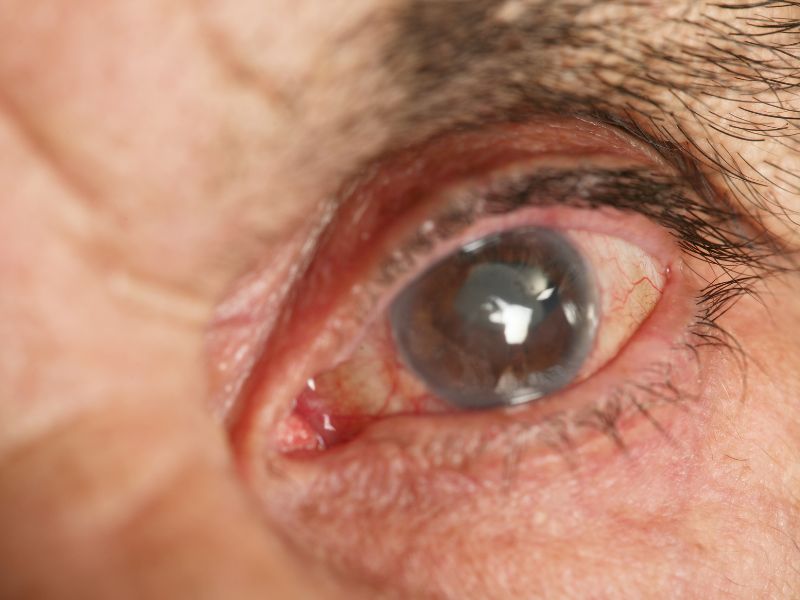 Cirurgia de Catarata com Laser em Curitiba Qual o Preço e Onde Fazer