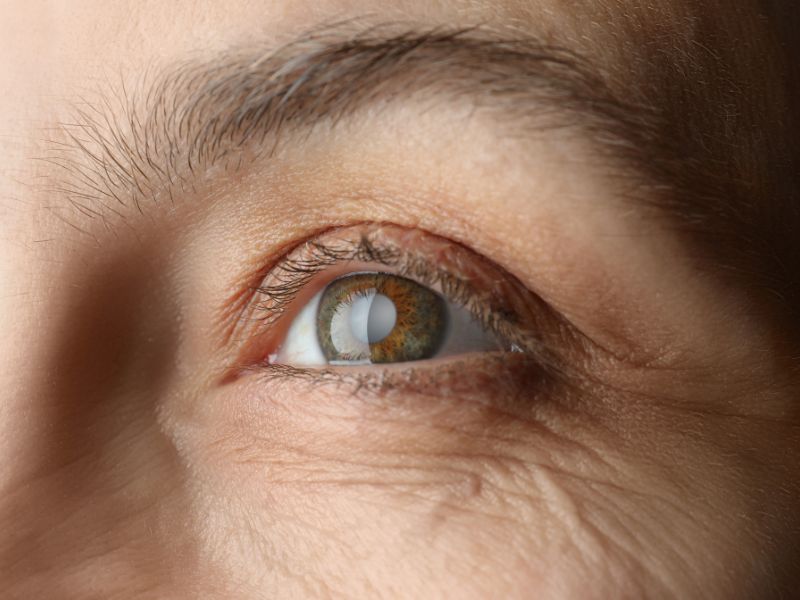 Tratamento Cirúrgico do Glaucoma em Curitiba com Avaliação Especializada