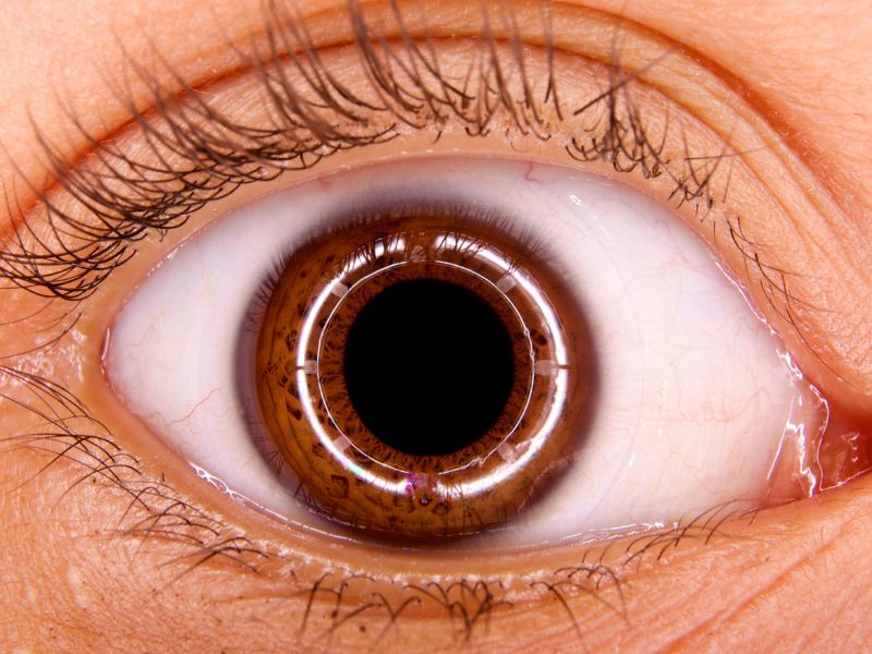 Vitrectomia em Curitiba para Descolamento de Retina Urgente